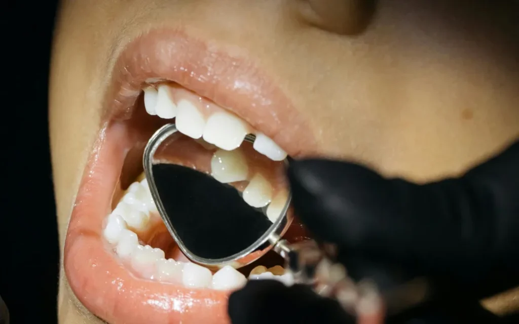 A close-up of a child's mouth with a dentist's mirror inside it.
