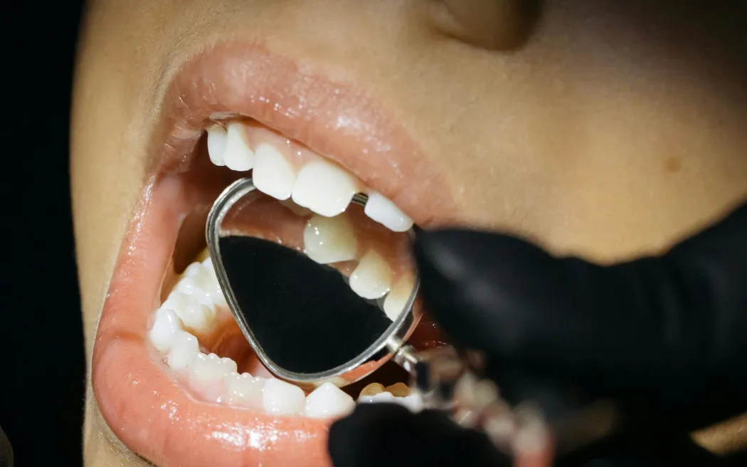 A close-up of a child's mouth with a dentist's mirror inside it.