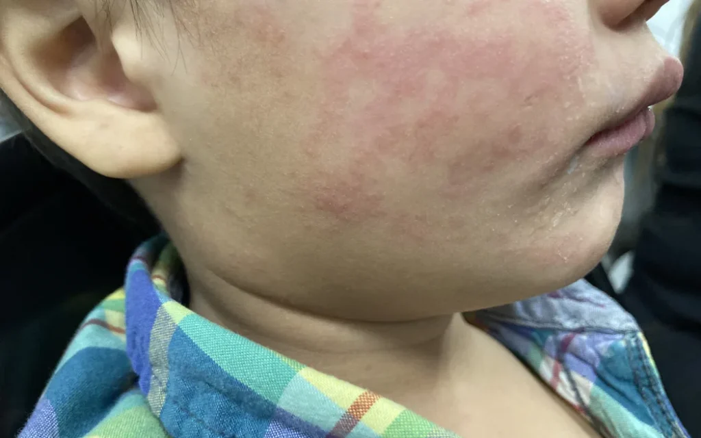 Dịch sởi bùng phát: Chuyên gia dự báo mức độ lan rộng sẽ rõ trong vài ngày tới 1 The characteristic rash caused by measles, on the cheek of a child infected with the virus, during an outbreak in the USA in 2024.