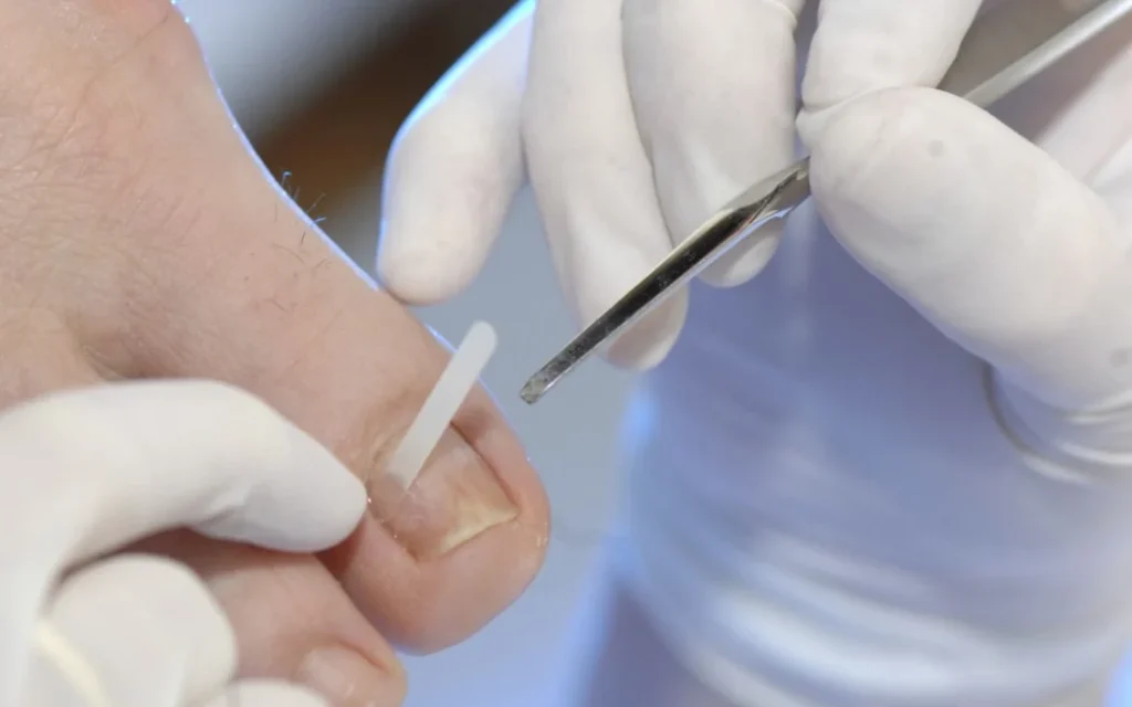 PEDICURE Photo essay from health professional's office. Photo essay in a podiatry surgery. Cares of podiatry. Orthonyxia placement of a strip on the nail to correct the curve. JOSE OTO / BSIP (Photo by JOSE OTO / BSIP / BSIP via AFP)