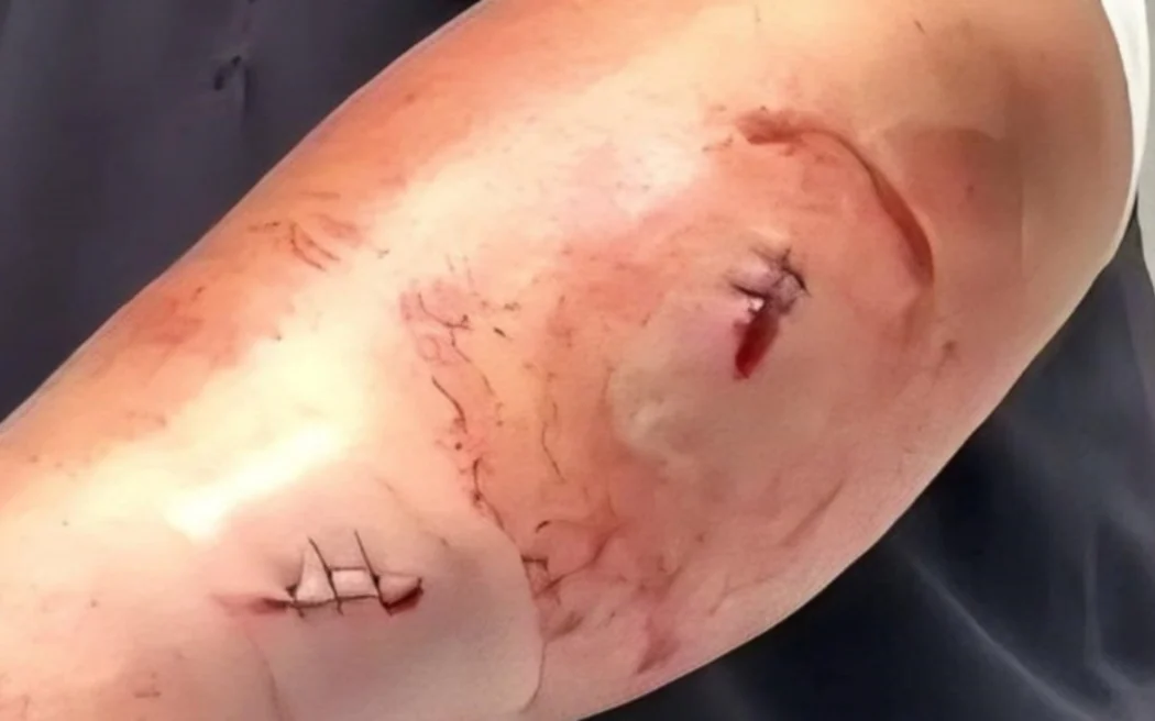 Stab wounds on Mary's arm.